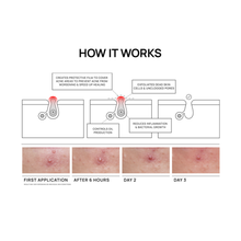 Load image into Gallery viewer, ACNE SPOT Invisible Shield